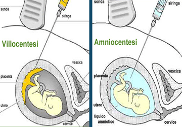 Amniocentesi o villocentesi